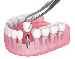 Different parts of dental implants