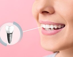 Digital dental implant and person’s smile