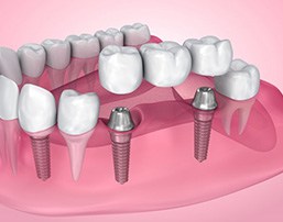 Illustration of dental bridge being placed on implants